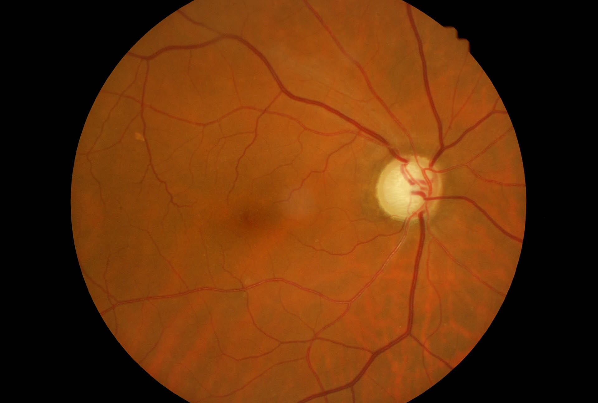 Venti anni senza terapia per IOP elevata